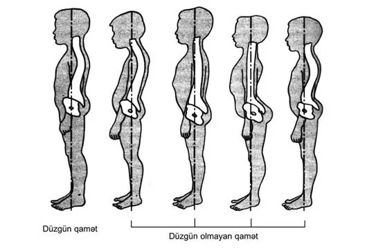 Uşaqlarda onurğa sütununun əyrilikləri. SƏBƏBLƏR, PROFİLAKTİKA