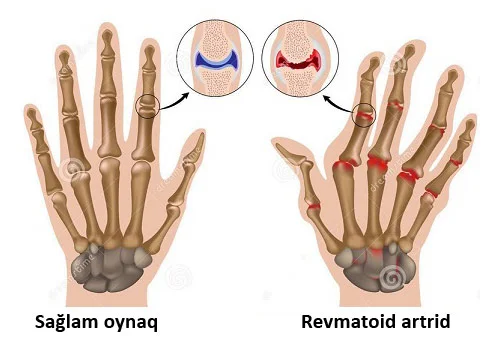 Revmatoid artrit ağır oynaq xəstəliyi FOTO