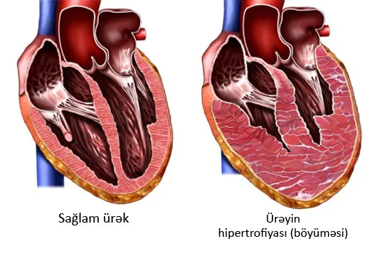 Ürəyin böyüməsi təhlükəli simptom