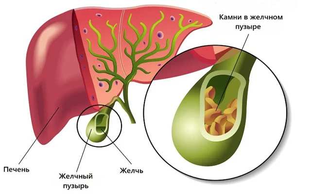 Qaraciyər və öd daşı xəstələrinin PƏHRİZİ