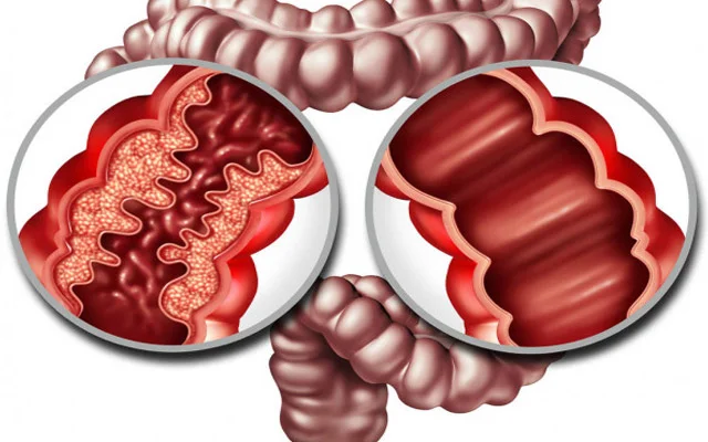 Keçməyən ishal, arıqlama, ağrılar... Kron xəstəliyi nədir və necə müalicə olunur?