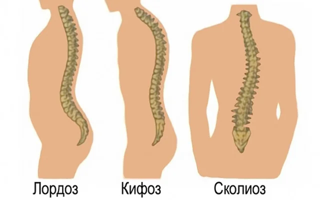 Lordoz və kifoz nədir?