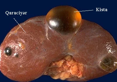 Qara ciyər kistaları