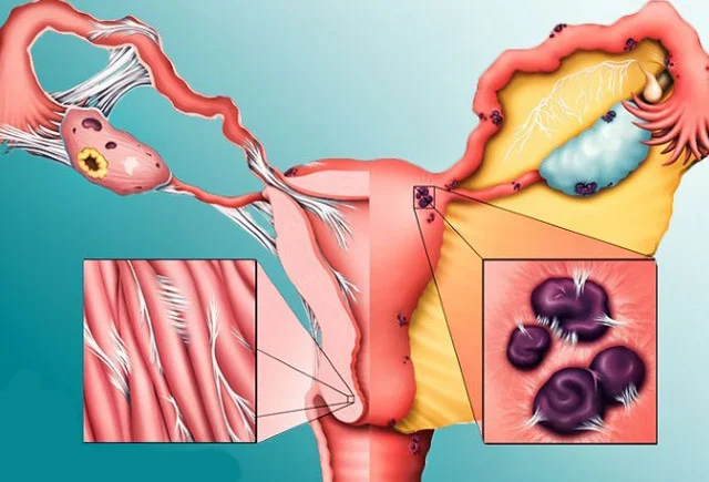 Ağrılı menstruasiyaların əsas səbəbi BU XƏSTƏLİKDİR