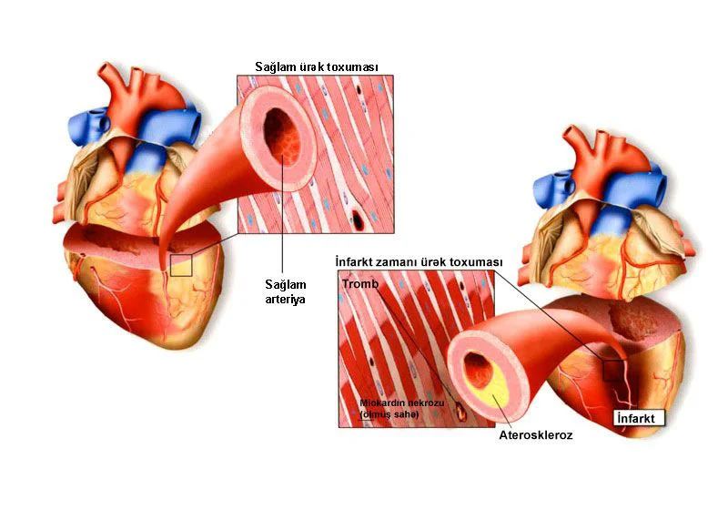 Miokardın infarktı nə deməkdir?