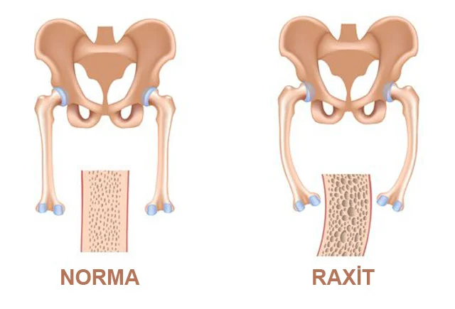 Valideynlərin diqqətinə! Uşaqlarda D vitamininin çatışmazlığı bu pozulmalara yol açır