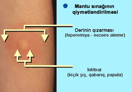 Mantu sınağı