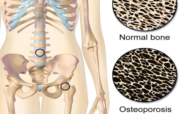 Sümük kütləsinin azalması OSTEOPOROZ. Səbəblər, simptomlar, müalicə