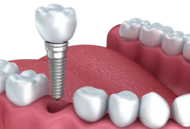 Diş implantının damağa ziyanı varmı?