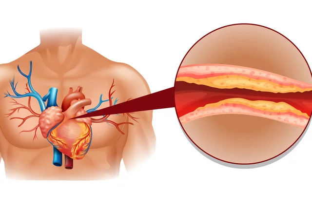 Damarlarda xolesterin və trombları əritmək üçün necə qidalanmaq lazımdır?