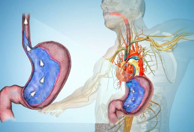Yüksək mədə turşuluğu infarkta səbəb ola bilər Qastroenteroloq