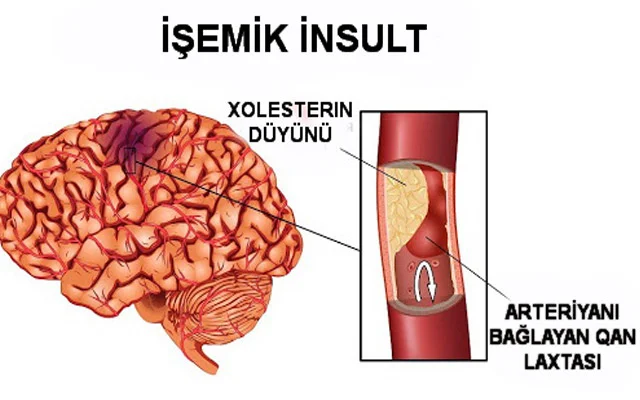 30 yaşdan sonra insultdan qorunmaq üçün nə etməli 7 MƏSLƏHƏT