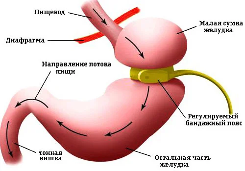 ЛЕЧЕНИЕ ОЖИРЕНИЯ. САМЫЙ ЭФФЕКТИВНЫЙ СПОСОБ