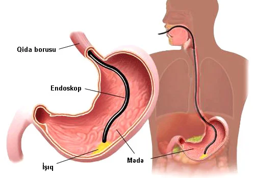 Mədə və on iki barmaq bağırsağı xorası xəstəliyinin diaqnostikası