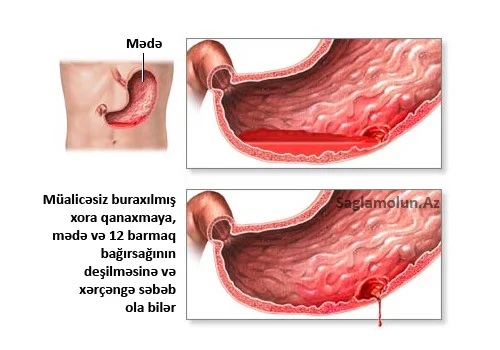 Xora xəstəliyinin ağırlaşmaları xoranın deşilməsi və daxili qanaxma