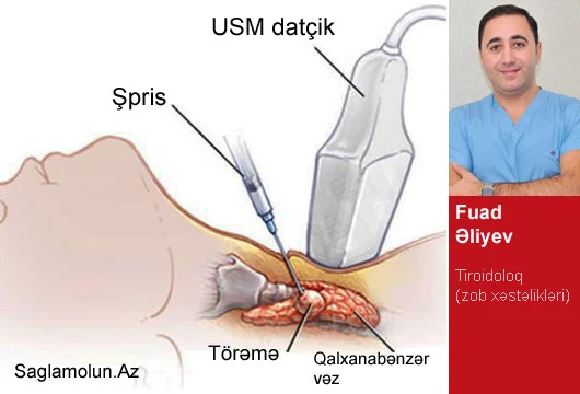 Qalxanabənzər vəzi xərçəngini aşkar edən ƏN DƏQİQ MÜAYİNƏ