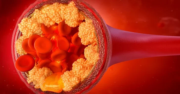 Найден способ снизить уровень плохого холестерина на 60%