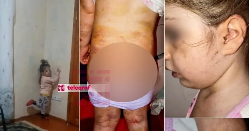 4 yaşlı qıza verilən işgəncələr: bədəni yandırılıb, kəmərlə döyülüb... FOTO