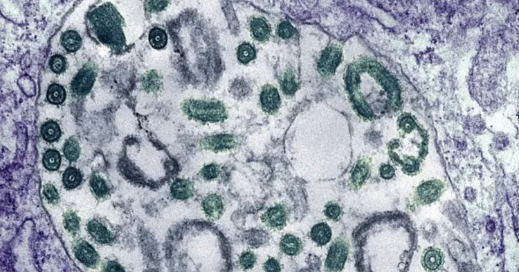 Efiopiyada təhlükəli virusun yayıldığı TƏSDİQLƏNDİ