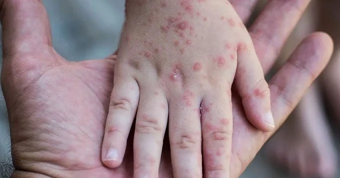 Qızılca yenidən yayılır: Peyvənd olunmayanlar...