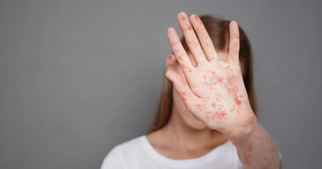 Qızılca yenidən yayılır: Peyvənd olunmayanlar...