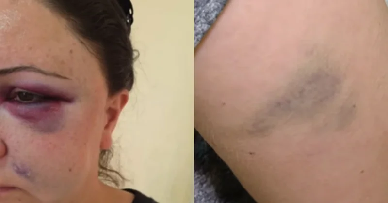 “Ata anam deyirdi hamı döyülə döyülə arvad olur” 14 il şiddət görən qadın danışdı+Video