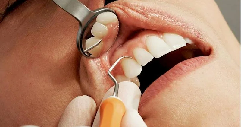 Diş ətinin iltihabı riskini azaldan məhsullar hansılardır?
