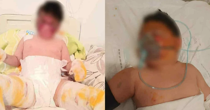 Ağır yanıq xəsarətləri alan 9 yaşlı Zaidin dəstəyinizə ehtiyacı var FOTO