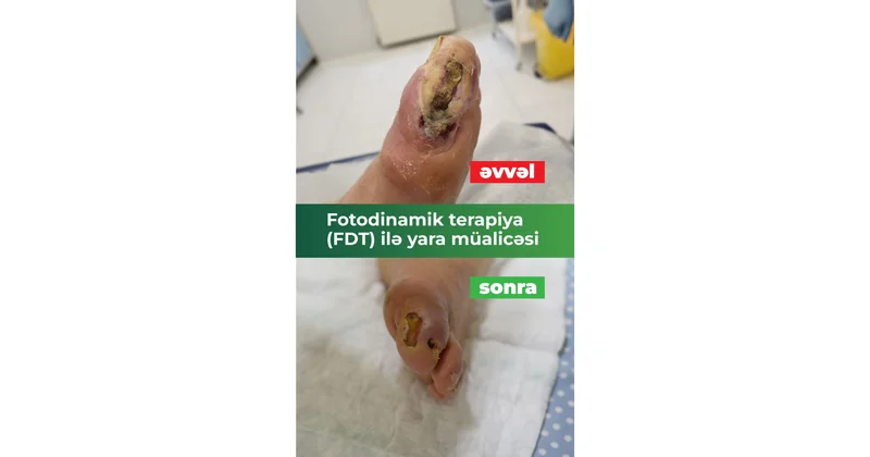 Ayağı kəsilməkdən xilas edən müalicə: Fotodinamik terapiya (FDT) ilə diabetik yaralarda sürətli sağalma VİDEO