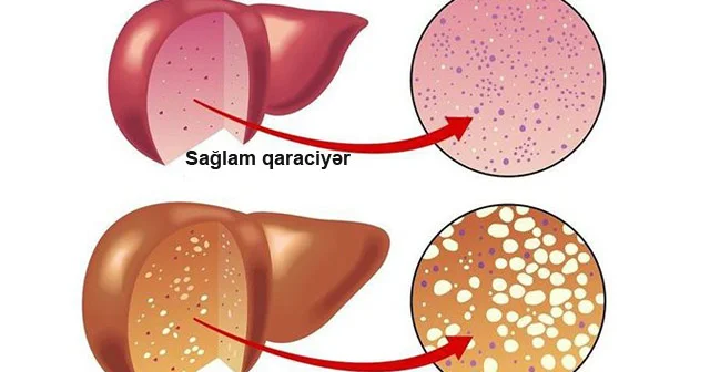 Bu 20 qəpiklik məhsul qaraciyərin yağlanmasını azaldır