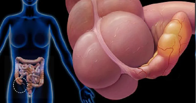 Appendisitin simptomları: Partlaması ölüm riski daşıyırmı?