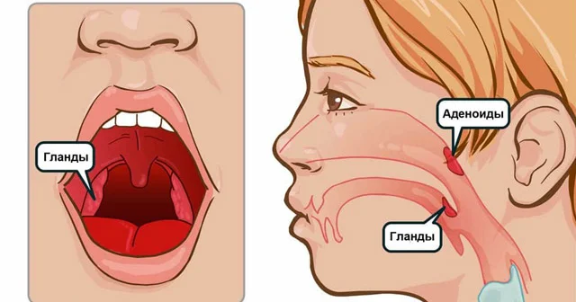 Burun əti uşağı kar edə bilər VALİDEYNLƏR, DİQQƏTLİ OLUN