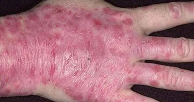 Psoriaz xəstələr üçün məsləhətlər