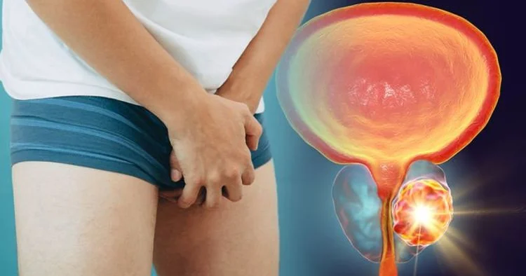 Prostat xənçəngini yaradan əsas səbəb KİŞİLƏRİN NƏZƏRİNƏ