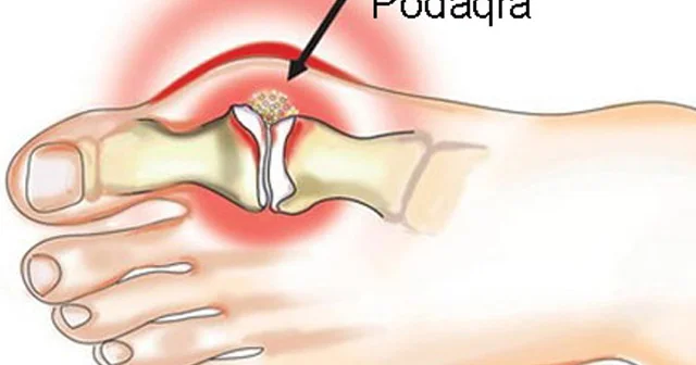 Krallar xəstəliyi PODAQRA. Səbəblər və müalicə
