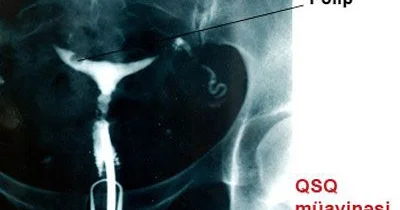 Uşaqlığın vəziyyəti və uşaqlıq boruları keçiriciliyinin müayinəsi