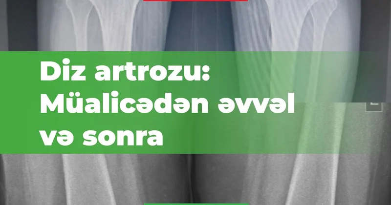 Artrozun fərqli müalicəsi! IV dərəcəli artroz II dərəcəyə gerilədi