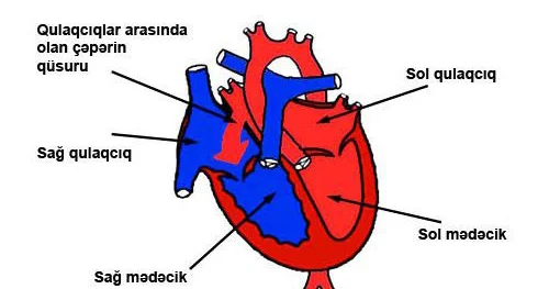 Anadangəlmə ürək qüsurları