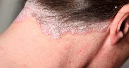 Psoriaz xroniki dəri xəstəliyi FOTO