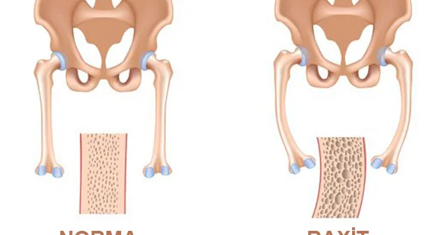 Valideynlərin diqqətinə! Uşaqlarda D vitamininin çatışmazlığı bu pozulmalara yol açır