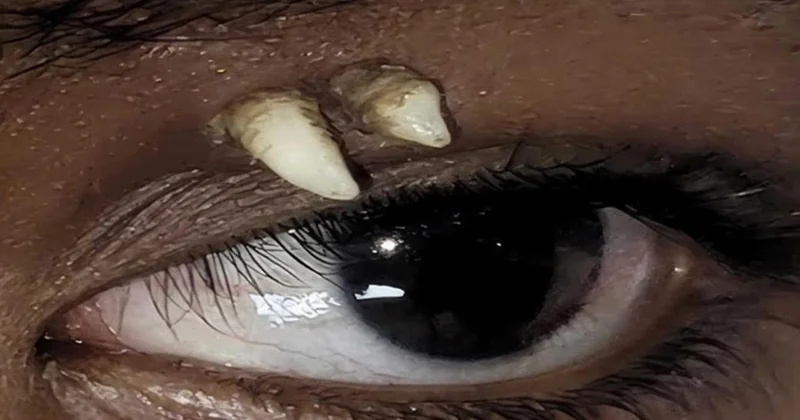 16 yaşlı oğlanın gözündən diş çıxdı Fotolar