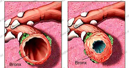 Bronxit. Risk faktorları və əlamətlər