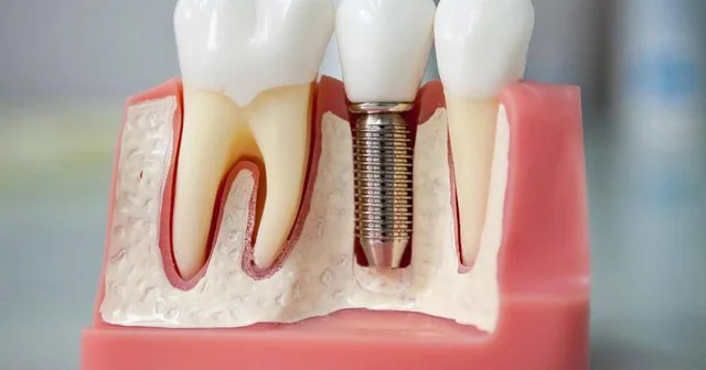 Diş implantını hamıya qoymaq olmaz Fəsadlar yaranır