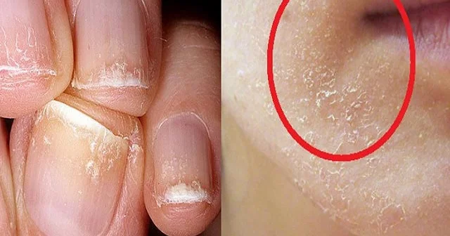 Dodaq kənarlarında çatlar, toyuq korluğu, quru dəri... Sizdə bu VİTAMİN çatışmır