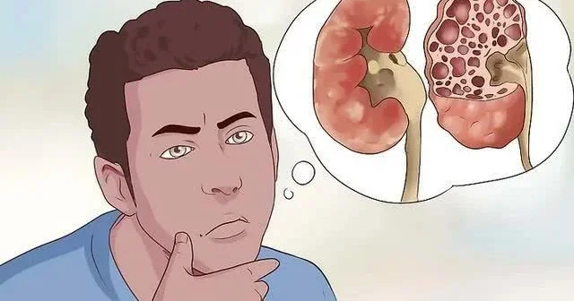 Böyrəkləri xroniki xəstəliklərdən necə qorumalı? Çox sadə TÖVSİYƏLƏR