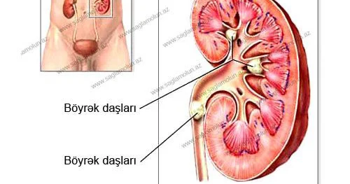 Böyrək daşı xəstəliyi