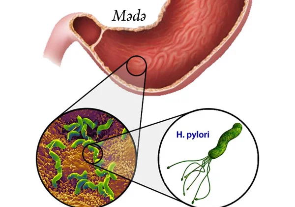 Mədə mikrobu hansı fəsadlara yol aça bilər?