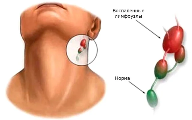 Limfadenit limfa düyünlərinin iltihabı