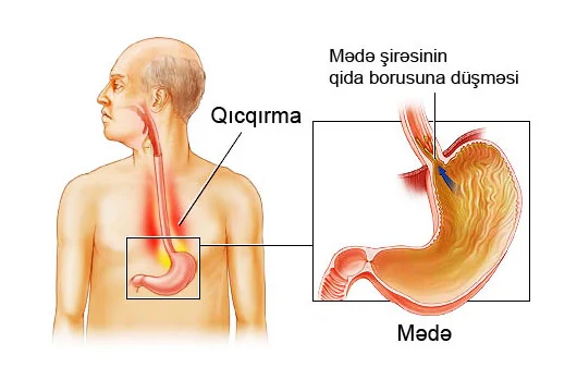 Qıcqırma təhlükəli ola bilər