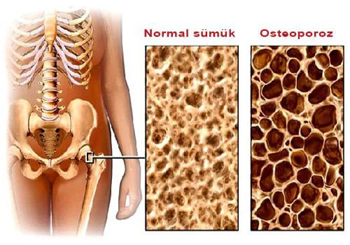 Qadınlarda osteoporoz xəstəliyi və klimaks